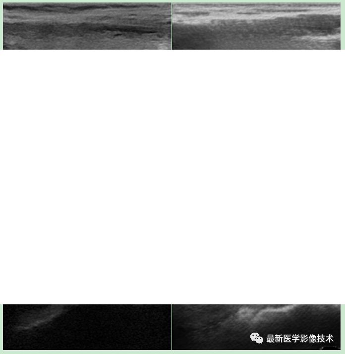 USenhance2023——2023 年超声图像增强挑战赛